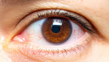 Yeux secs : Comment soulager la sécheresse oculaire ?